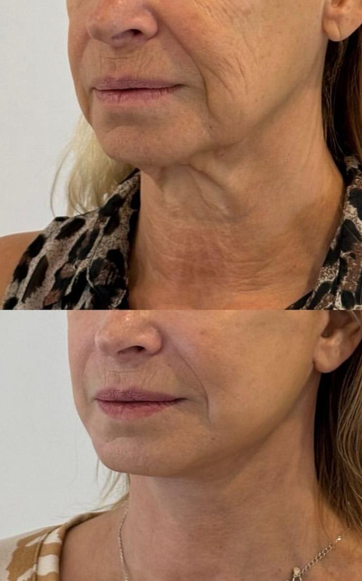 Cintas Lifting Facial Anti-Edad Transparentes